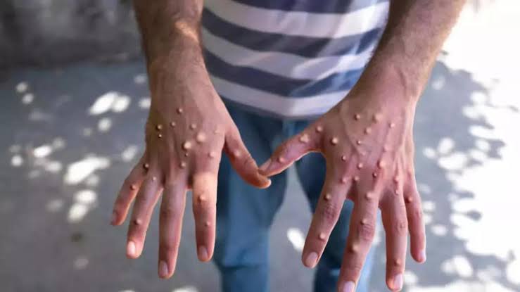 What You Need To Know About M-pox
